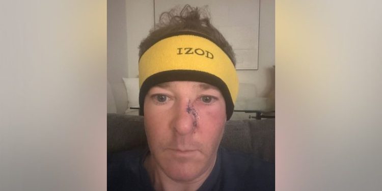 EPA administrator Lee Zeldin reveals he underwent surgery to remove skin cancer from his face